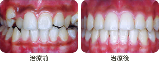 新井矯正歯科 矯正治療例