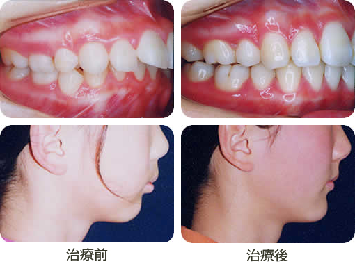 新井矯正歯科 矯正治療例