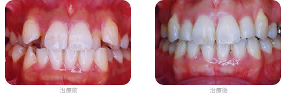 成人の矯正治療例 治療前 治療後