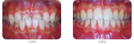 矯正治療例 受け口、下顎前突、反対咬合