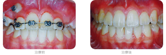 矯正治療例 埋伏